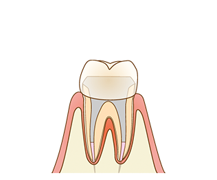 根管治療が終わったら土台を作成し最終的に被せ物をして歯の治療が完了します