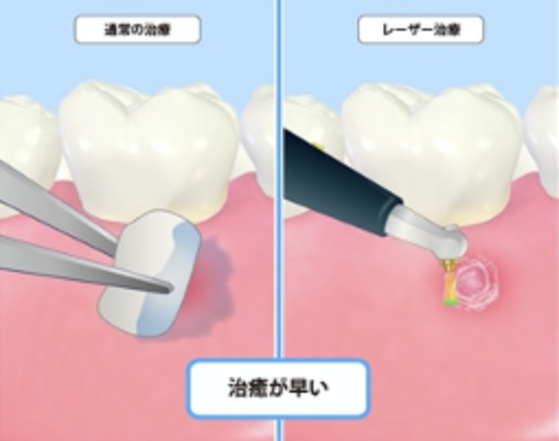 レーザーを使用することで歯肉の切除や切開をすることができます。
