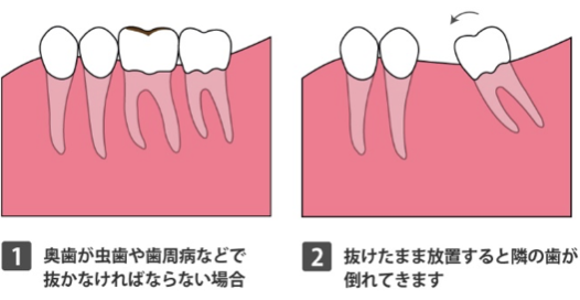 横の歯が倒れてくる、反対側の歯が噛む相手を探そうと突出してしまう
